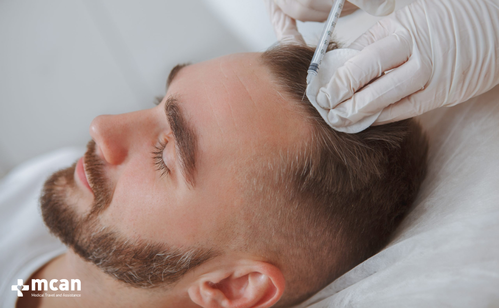 Crown Hair Transplant: Causes of Balding Crown and Treatment Options 4 Non Surgical Treatment Options for Crown Balding Non Surgical Treatment Options for Crown Balding