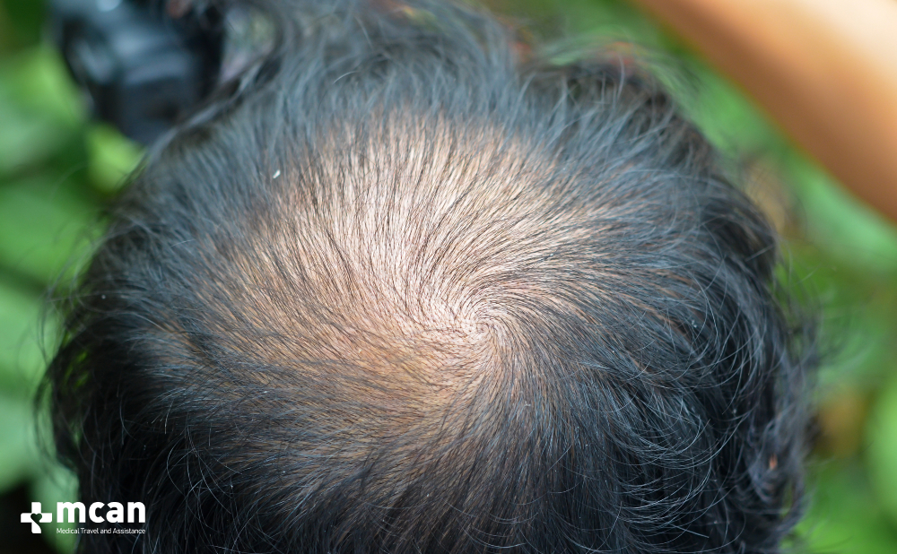 Crown Hair Transplant: Causes of Balding Crown and Treatment Options 3 Signs of Crown Hair Loss Signs of Crown Hair Loss