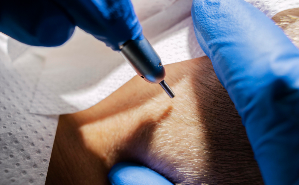 Hair Transplant Scars: What You Need to Know 2 Types of Hair Transplant Scars FUE Scars Types of Hair Transplant Scars FUE Scars