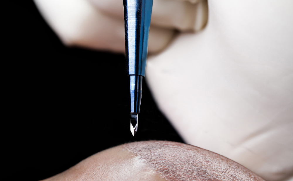 Hair Transplant Scars: What You Need to Know 4 Types of Hair Transplant Scars Sapphire FUE Scars Types of Hair Transplant Scars Sapphire FUE Scars