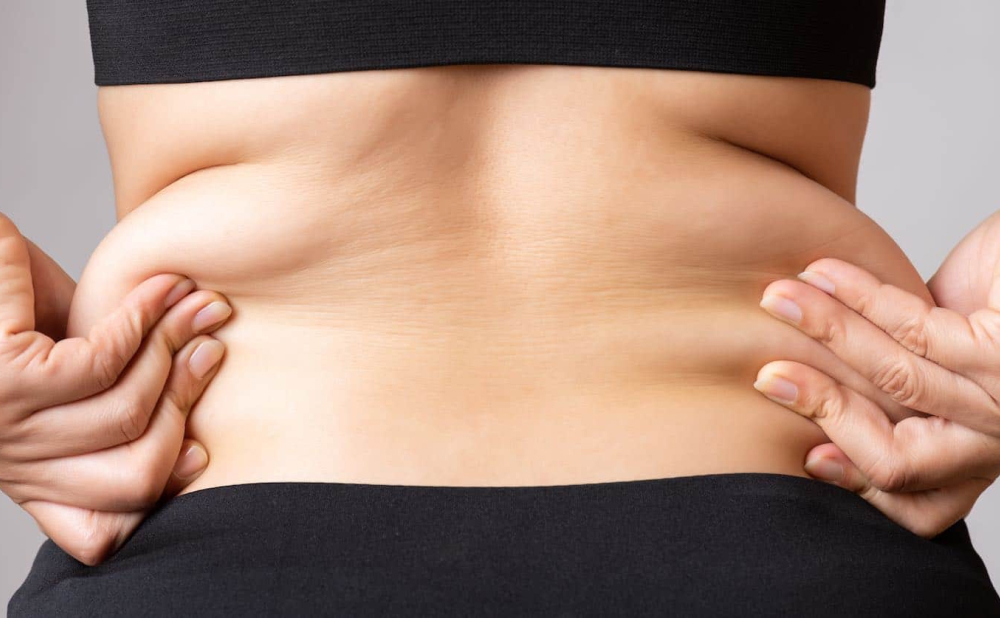 Love Handle Liposuction: Sculpting Your Waistline 2 What Are Love Handles What Are Love Handles