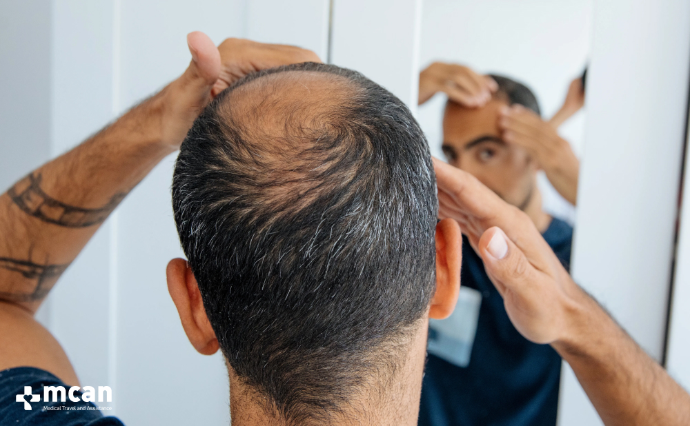 Crown Hair Transplant: Causes of Balding Crown and Treatment Options 2 What is Crown Balding What is Crown Balding