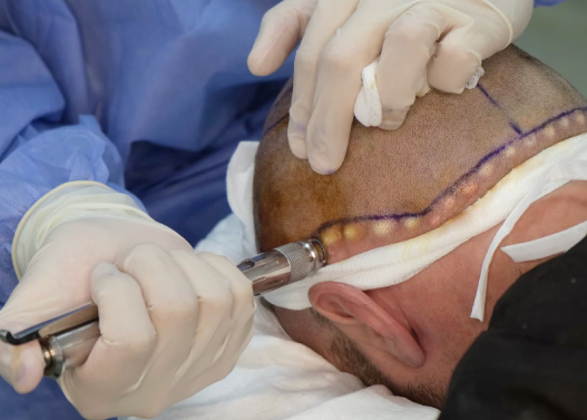 Why Choose a Needle Free Hair Transplant