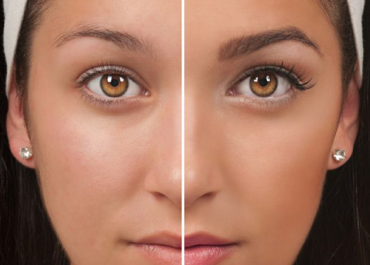 Why Should You Get Eyebrow Transplant in Turkey