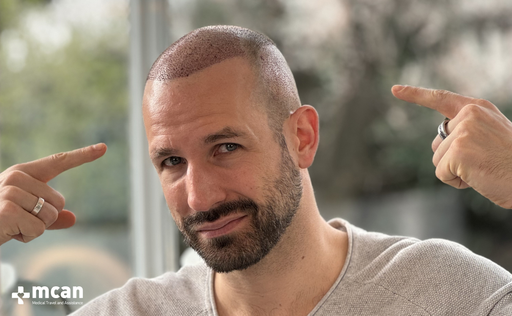 Achieve Hair Transplant Success with Trusted Expertise in Turkey