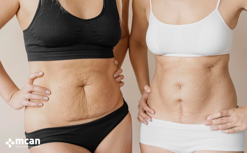 Mommy Makeover Uncovered: Why a Mommy Makeover Isn’t Just for Moms 3 Beyond Pregnancy Who Can Benefit from a Mommy Makeover Beyond Pregnancy Who Can Benefit from a Mommy Makeover