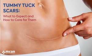 Cover Tummy Tuck Scars