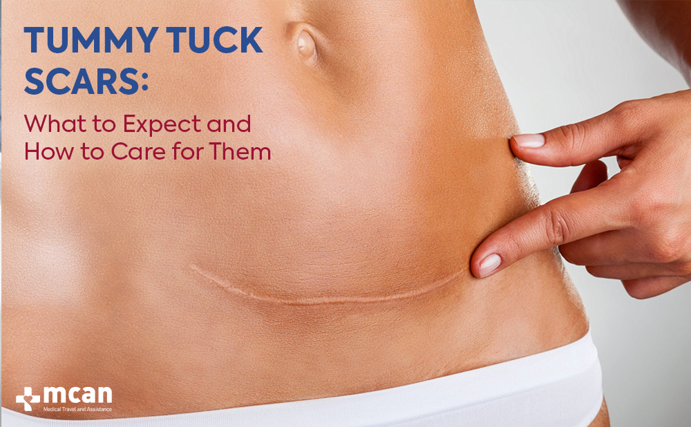Tummy Tuck Scars: What to Expect and How to Care for Them 1 Cover Tummy Tuck Scars Cover Tummy Tuck Scars