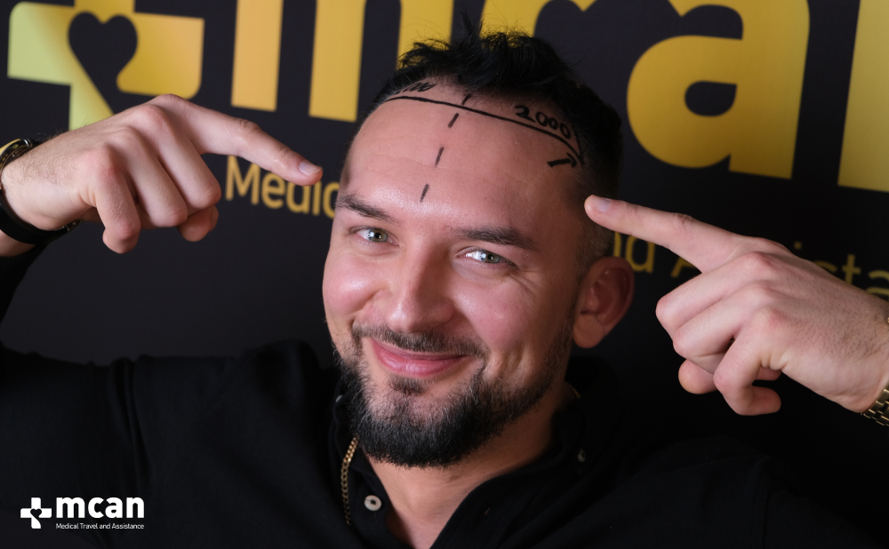 Defining Success in a Hair Transplant