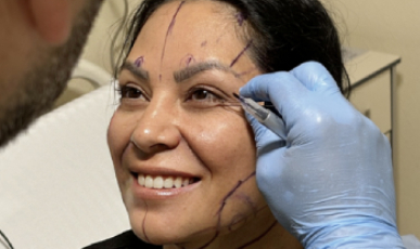 Eyelid Surgery