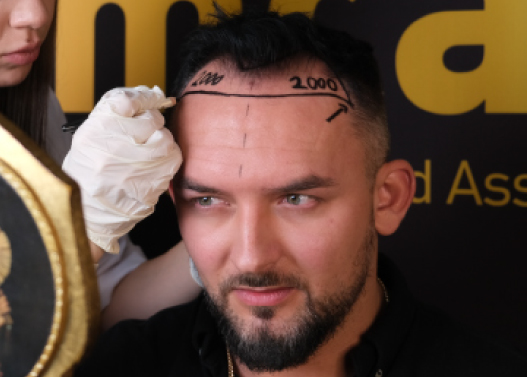 Hair Graft Calculator 4 How Many Grafts Do You Need How Many Grafts Do You Need