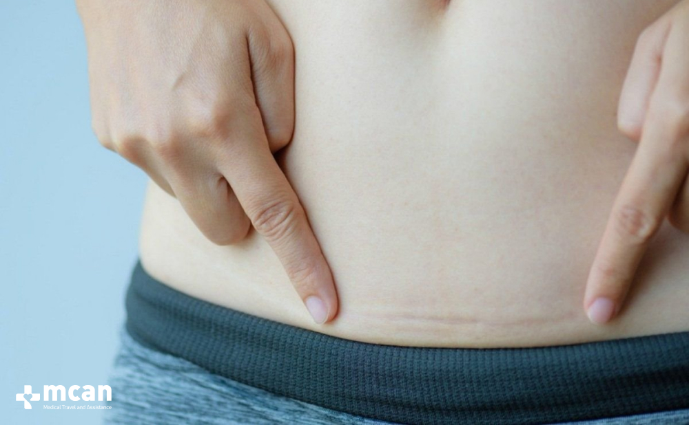 Tummy Tuck Scars: What to Expect and How to Care for Them 3 How Tummy Tuck Scars Change Over Time How Tummy Tuck Scars Change Over Time