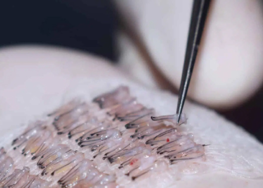 Hair Graft Calculator 5 Important Reminder Important Reminder