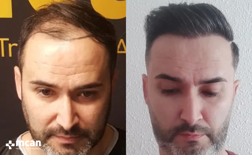 Juan M. %E2%80%93 FUE 4200 Grafts 1 Year Result