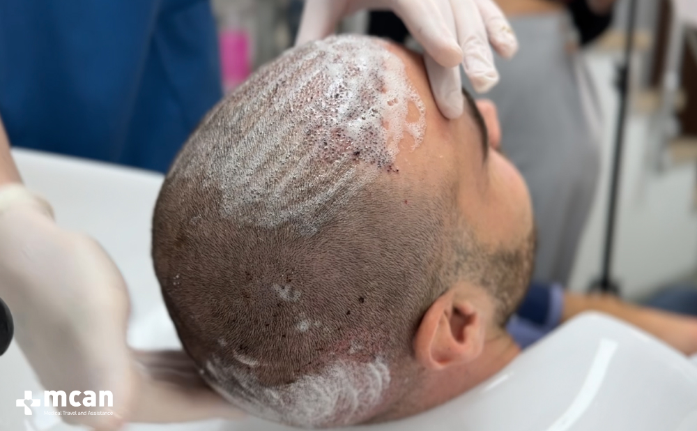 Post Operative Aftercare Where Hair Transplant Success Is Protected