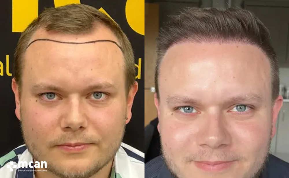 Scott G. %E2%80%93 FUE 2750 Grafts 8 Month Result