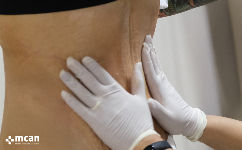 Tummy Tuck Scars: What to Expect and How to Care for Them 5 Tummy Tuck in Turkey with MCAN Health Tummy Tuck in Turkey with MCAN Health