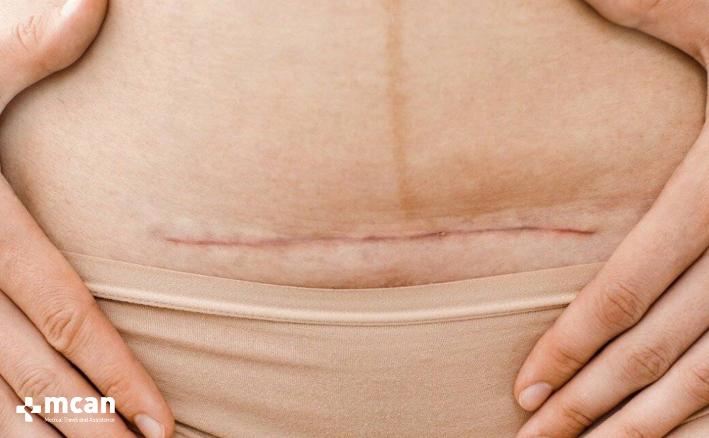 Tummy Tuck Scars: What to Expect and How to Care for Them 2 What Is a Tummy Tuck Scar What Is a Tummy Tuck Scar