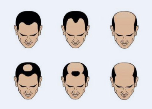 What is Norwood Hamilton Scale