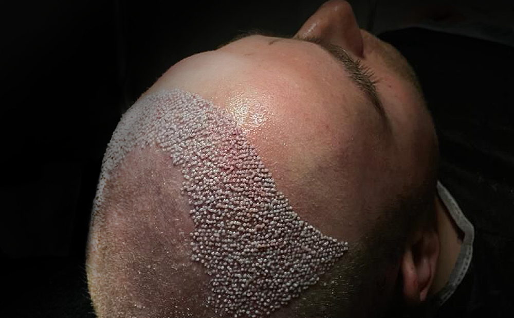 When Grafts Are Considered Safe During Sleep