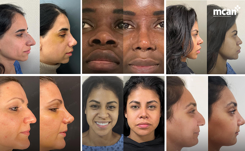 Ethnic Rhinoplasty: Enhancing Natural Beauty Respectfully 2 Ethnic Rhinoplasty Enhancing Natural Beauty Respectfully 2 1 Ethnic Rhinoplasty Enhancing Natural Beauty Respectfully 2 1
