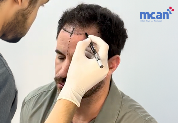 Hair Transplant in Turkey with MCAN Health 2