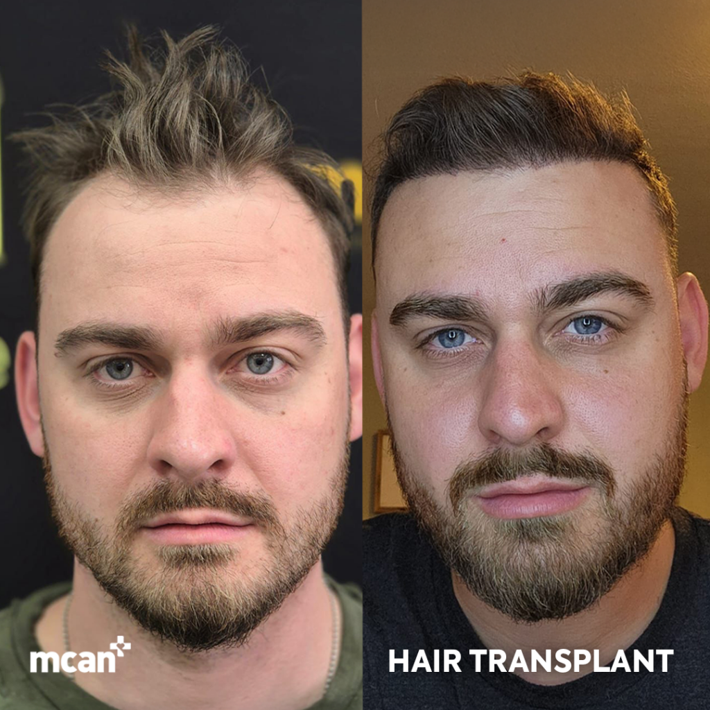 How Turkey Became a Global Leader in Hair Transplant 2