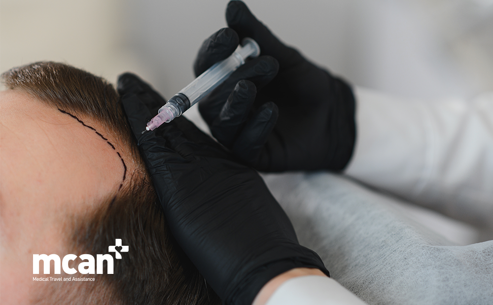 Why Is the Donor Area So Important in Hair Transplant
