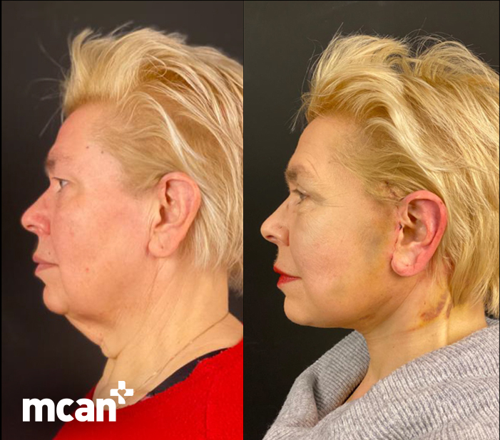 What Is a Mini Facelift? Who It’s For and What to Expect 3 2What to Expect from the Mini Facelift Procedure 2What to Expect from the Mini Facelift Procedure