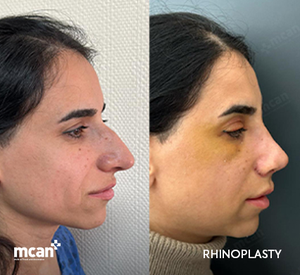 Ethnic Rhinoplasty: Enhancing Natural Beauty Respectfully 3 Common Goals and Challenges in Ethnic Rhinoplasty 1 Common Goals and Challenges in Ethnic Rhinoplasty 1