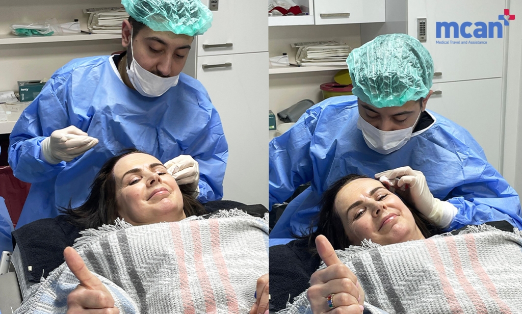What Is a Mini Facelift? Who It’s For and What to Expect 5 Mini Facelift in Turkey with MCAN Health Mini Facelift in Turkey with MCAN Health