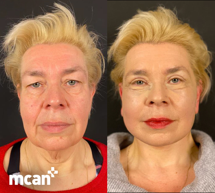 What Is a Mini Facelift? Who It’s For and What to Expect 4 What to Expect from the Mini Facelift Procedure What to Expect from the Mini Facelift Procedure