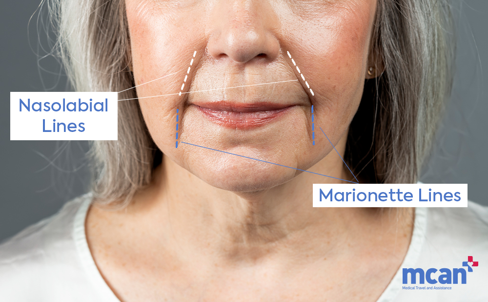 What Is a Mini Facelift? Who It’s For and What to Expect 2 Who Is a Good Candidate for a Mini Facelift Who Is a Good Candidate for a Mini Facelift