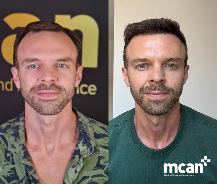Why Do People Go to Turkey for Hair Transplant? 2 Expert Level Surgical Experience at Scale 1 Expert Level Surgical Experience at Scale 1