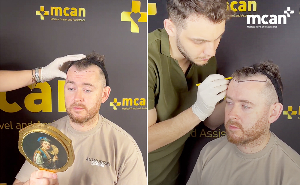 Finasteride After Hair Transplant: Is It Necessary? 2 What Is Finasteride And What Does It Really Do What Is Finasteride And What Does It Really Do