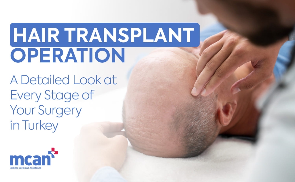 Hair Transplant Operation: A Detailed Look at Every Stage of Your Surgery in Turkey 1 EN HAIR TRANSPLANT OPERATION EN HAIR TRANSPLANT OPERATION