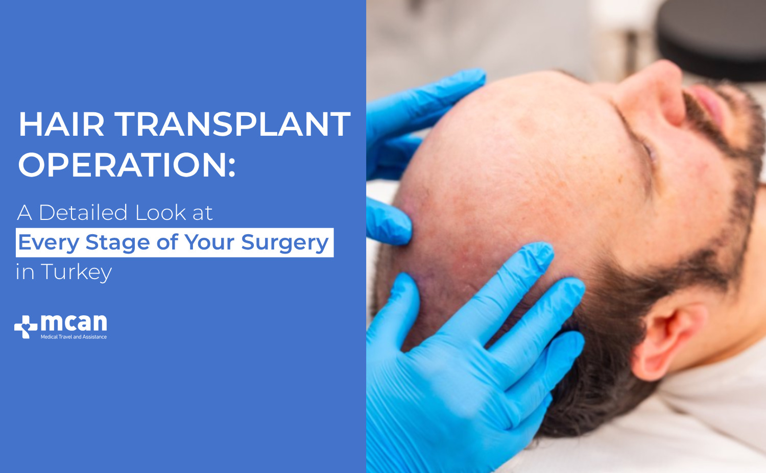 Hair Transplant Operation Cover