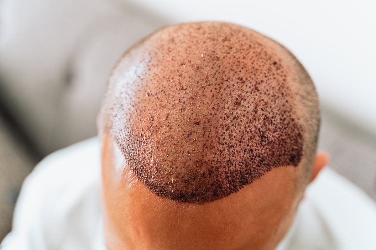 Hair Transplant Operation: A Detailed Look at Every Stage of Your Surgery in Turkey 3 Hair Transplant Post Operative Care and Recovery Hair Transplant Post Operative Care and Recovery