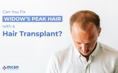 Can You Fix Widows Peak Hair with a Hair Transplant 1