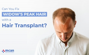 Can You Fix Widows Peak Hair with a Hair Transplant 1