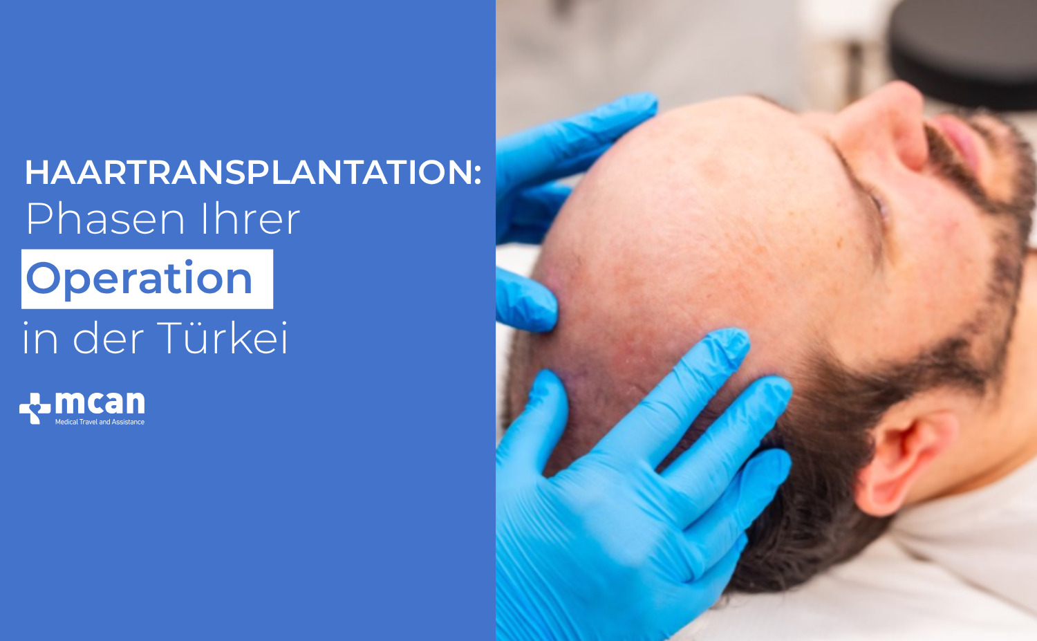 Haartransplantation Phasen Ihrer Operation in der Turkei