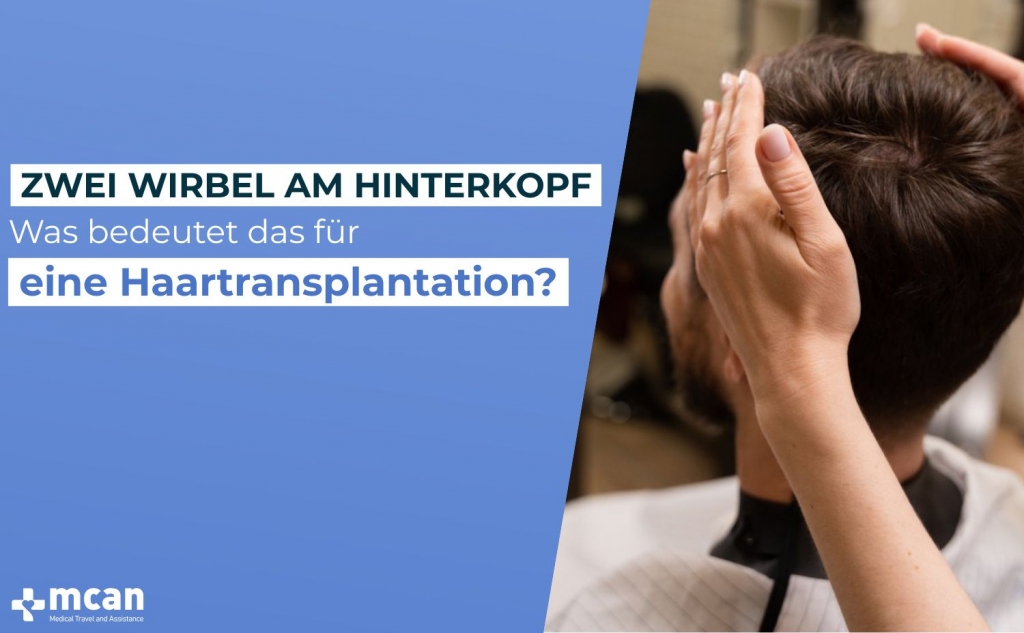 Zwei Wirbel am Hinterkopf: Was bedeutet das für eine Haartransplantation? 1 Was bedeutet das fur eine Haartransplantation Was bedeutet das fur eine Haartransplantation