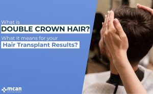 What is Double Crown Hair What It Means for Your Hair Transplant Results Cover