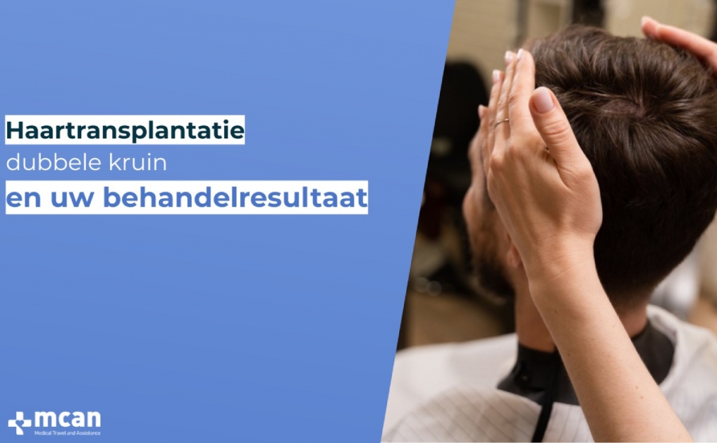 Haartransplantatie: dubbele kruin en uw behandelresultaat 3 haartransplantatie dubbele kruin en uw behandelresultaat haartransplantatie-dubbele-kruin-en-uw-behandelresultaat