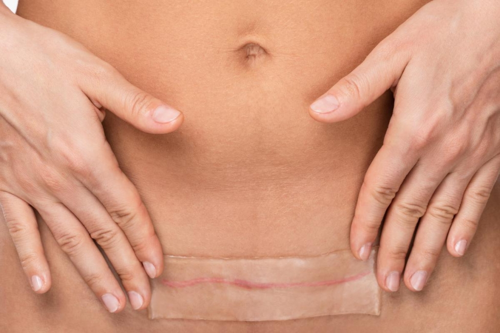 mini tummy tuck incision and scar placement