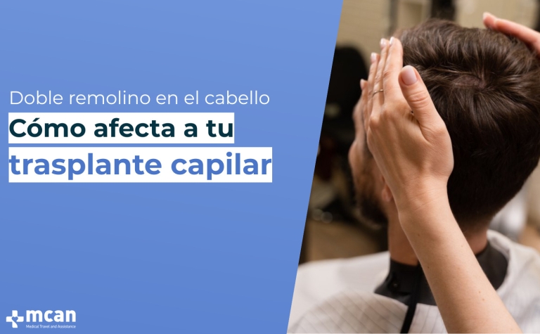 Trasplante capilar sin agujas 50 Blog Cover Que es el doble remolino en el cabello ¿Qué es el doble remolino en el cabello y qué significa para los resultados de tu trasplante capilar?