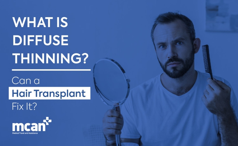 What Is Diffuse Thinning? Can a Hair Transplant Fix It? 7 EN What Is Diffuse Thinning min EN What Is Diffuse Thinning min