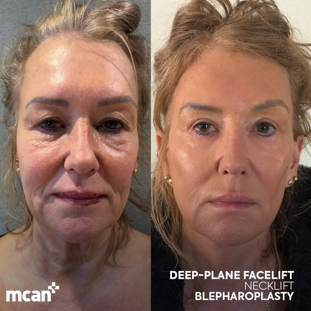 Facelift Before After 1 min