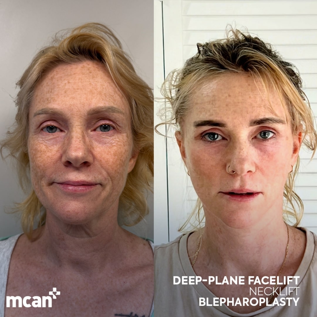 Facelift Before After 3 min