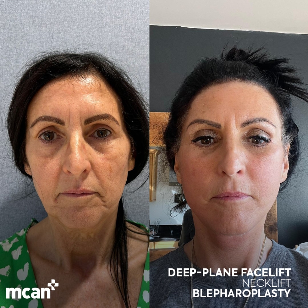 Facelift Before After 4 min